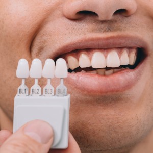 A Step-by-Step Guide to Getting Veneers in Annapolis A Step-by-Step Guide to Getting Veneers in Annapolis