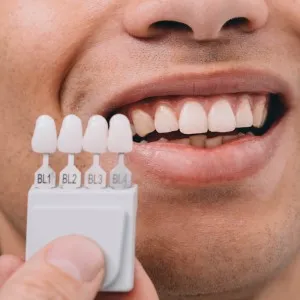 A Step-by-Step Guide to Getting Veneers in Annapolis