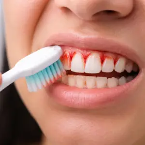 Helpful dental information about gum disease in Annapolis and bleeding gums when brushing.