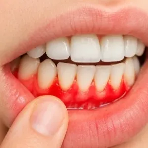Early Signs to Watch For Regarding Gum Disease in Annapolis