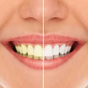 Essentiality of Professional Teeth Whitening | Annapolis, MD