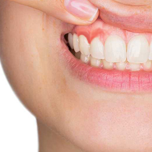 Gum Disease Needs Help: Busting the Myths
