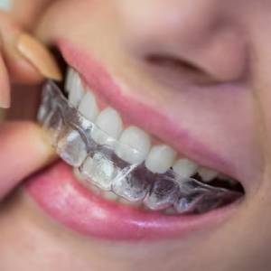 Invisalign Treatment by a Cosmetic Dentist in Annapolis