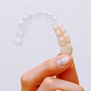 Is Invisalign Good for Children? | Annapolis