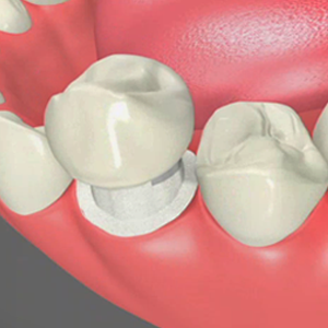 Dental Crowns in Annapolis
