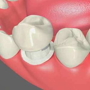 Dental Crowns in Annapolis Dental Crowns in Annapolis