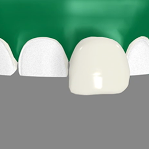 Dental Veneers in Annapolis