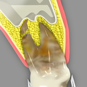 Tooth Extraction Annapolis Tooth Extraction
