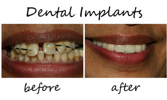 Dental Implants 1