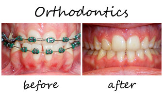 Orthodontics 3