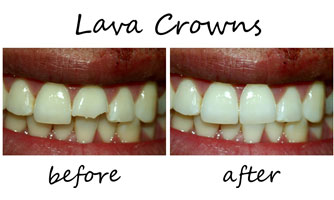 Dental Crowns 4