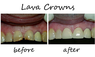 Dental Crowns 5